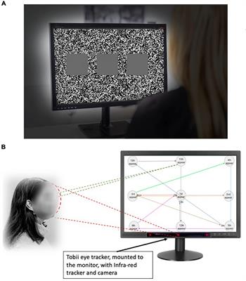 Stereopsis and Eye Movement Abnormalities in Parkinson’s Disease and Their Clinical Implications